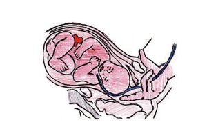 Pulsioximetria fetal