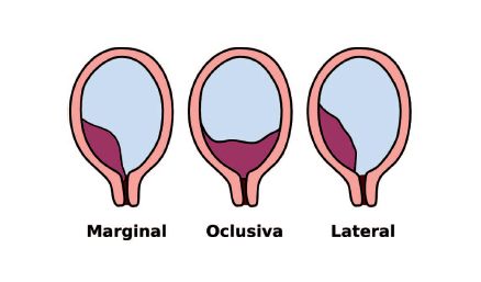 Tipos de placenta previa